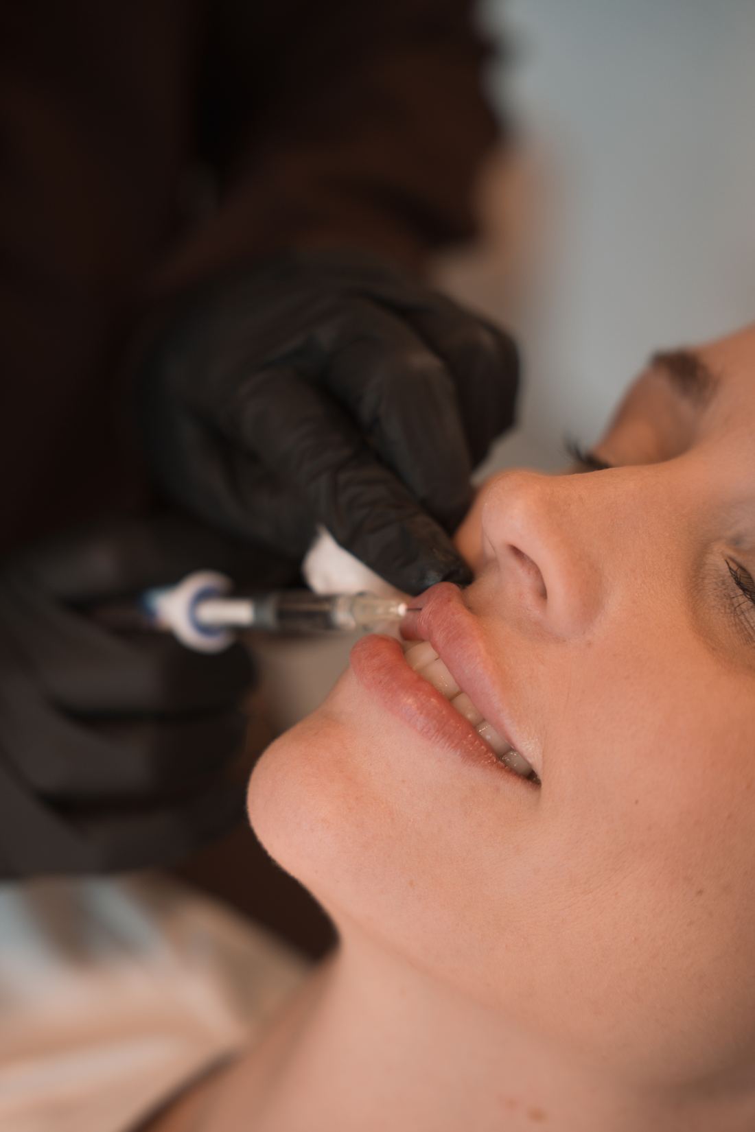 Perfilado de labios con ácido hialurónico